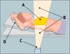 radiation_treatment2[2]